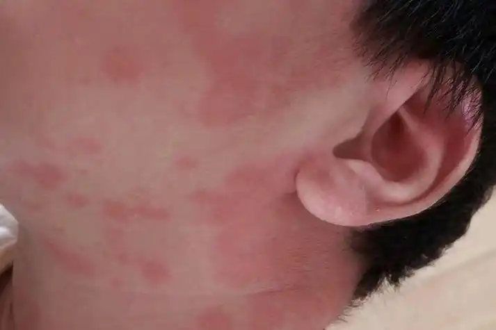 旧金山再现麻疹，未接种婴儿感染